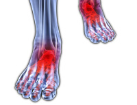 Inflammation (Morton’s Neuroma)