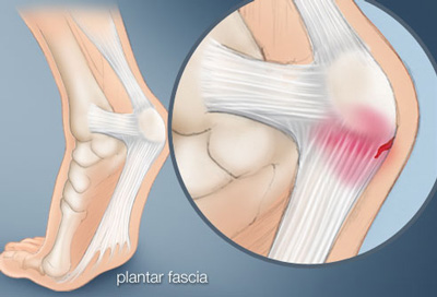 Plantar fasciitis